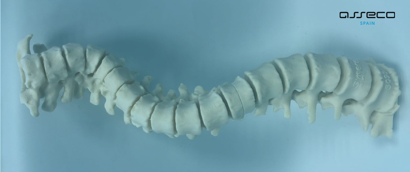 Tecnología de impresión 3D avanzada para corregir la escoliosis vertebral